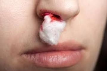 गर्मी में नाक से खून आना आम बात लेकिन अधिक रक्तस्त्राव हो सकता है गंभीर